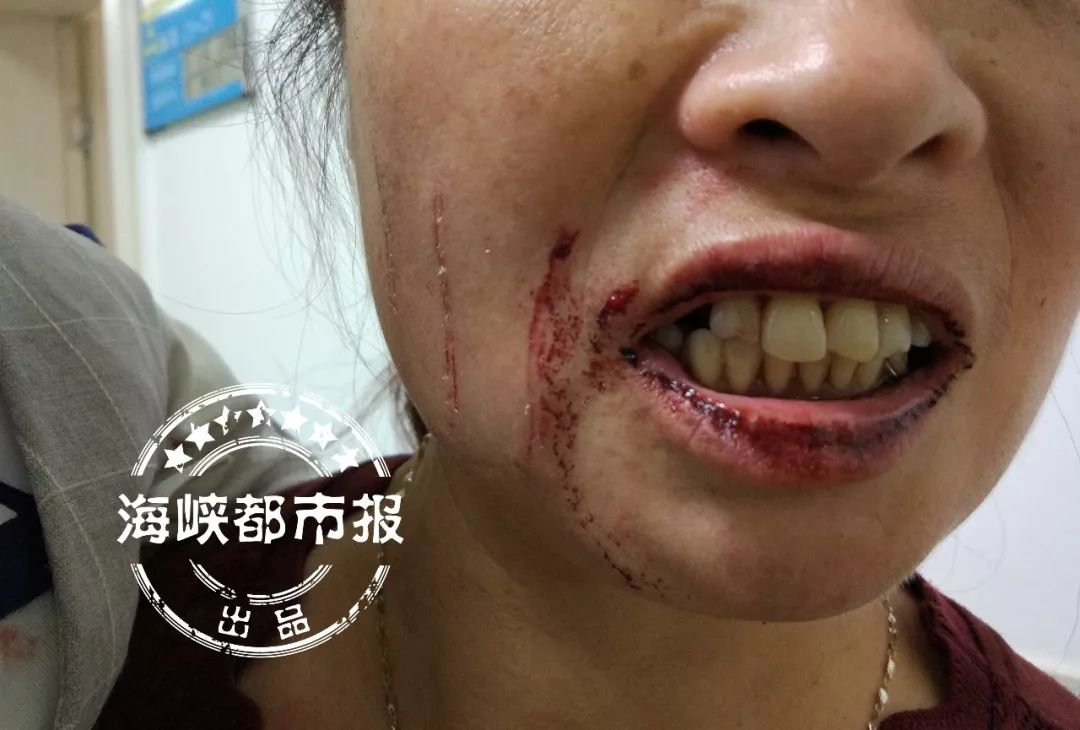 刚到福州,怎料电梯突然"逆行"!孙子脑后摔出"窟窿",奶奶满嘴鲜血