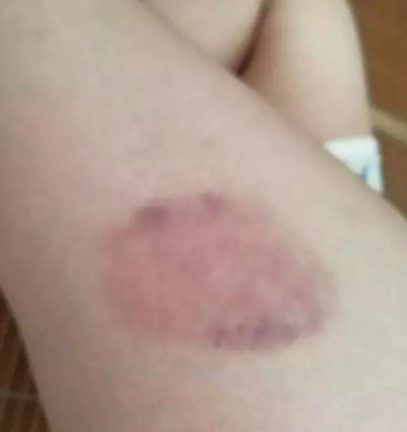 腿部淤青